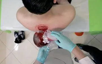 حجامت در بهار؛ آری یا خیر؟