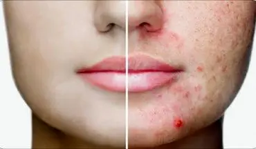  ارتباط بین آکنه و محصولات لبنی| مراقب باشید!