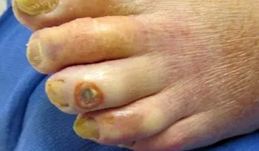 درمان  زخم پای دیابتی  با این راهکارها!