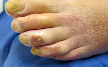 درمان  زخم پای دیابتی  با این راهکارها!