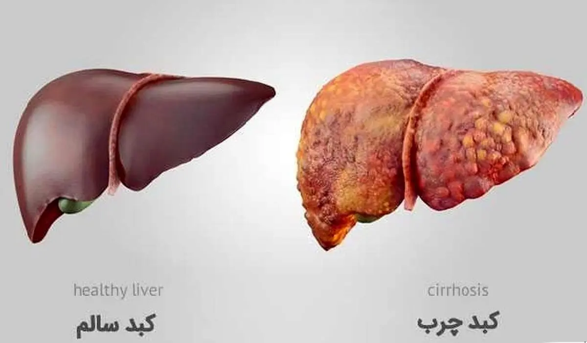 پایان کبد چرب/ قدرت شگفتانگیز انتخابهای روزمره شما!