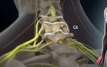 دردهای منتشر دیسک گردن کدام است؟