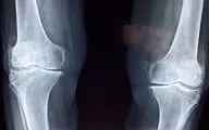 چند نکته درباره بیماری خاموشی که بی‌صدا استخوان‌ها را می‌شکند