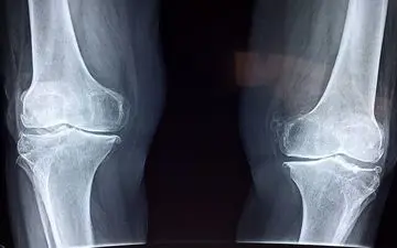 چند نکته درباره بیماری خاموشی که بی‌صدا استخوان‌ها را می‌شکند