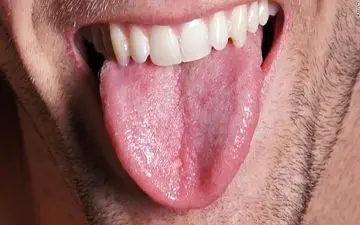 ارتباط چربی اضافی با آپنه خواب