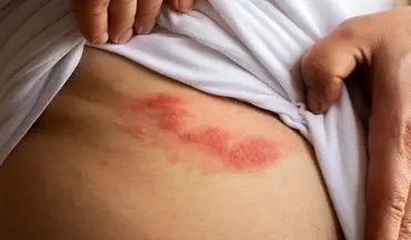 خطر زوال عقل در کمین مبتلایان مکرر به زونا