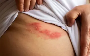 خطر زوال عقل در کمین مبتلایان مکرر به زونا