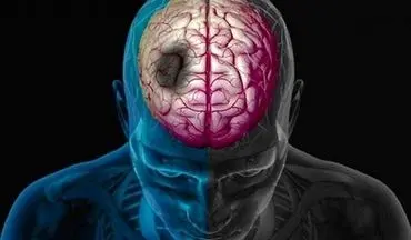 به این دلیل ساده خطر سکته در جوانان ۲ برابر می شود