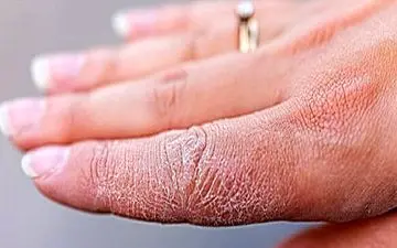 خطاهای رایج پوستی در هوای سرد