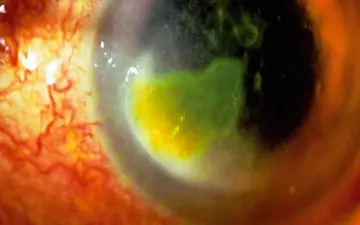 عوامل مؤثر در ایجاد کراتیت