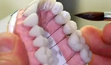 دندان لق، سوغات دندانسازهای غیرمجاز ترکیه‎ای برای تبریزی‎ها