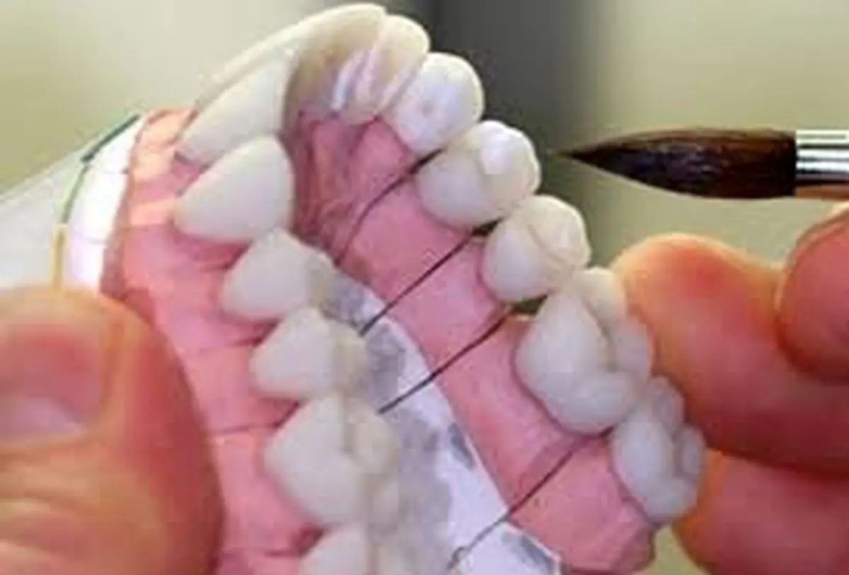 دندان لق، سوغات دندانسازهای غیرمجاز ترکیه‎ای برای تبریزی‎ها