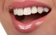 لبخندی درخشان و سفید با پیشگیری و راه های از بین بردن سیاهی دندان
