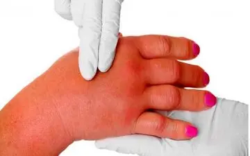 ورم و نشانه ها، علائم، علت و درمان های دارویی و گیاهی آن