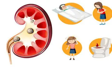 علل ابتلا به سنگ کلیه