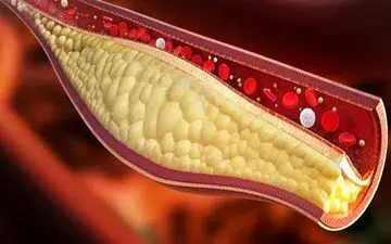 چربی خون در بدن چه علائمی دارد