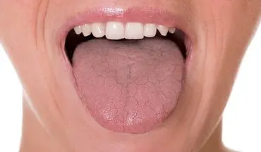 دلیل خشک شدن دهان دیابتی ها چیه؟