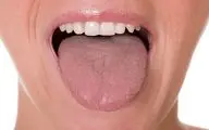 دلیل خشک شدن دهان دیابتی ها چیه؟