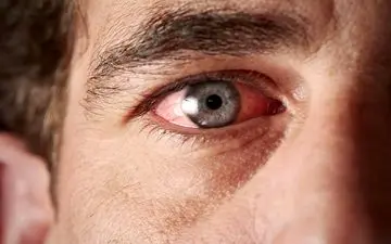 چرا چشم سالمندان مدام پر از اشک می‌شود؟ پاسخ یک جراح چشم