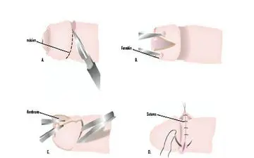 ختنه و فواید آن برای سلامتی مردان