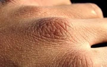 
این افراد بیشتر در معرض خشکی پوست هستند