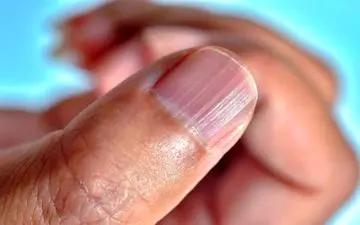 شیارهای ناخن/ چه چیزی پشت این علامت‌های نگران‌کننده نهفته است؟