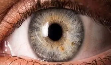 لکه‌های روی عنبیه چشم ، چه چیزی درمورد سلامتتان می گوید؟
