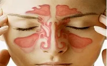 هنگام سینوزیت، لبنیات ممنوع!