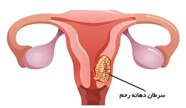 علائم هشدار دهنده سرطان دهانه رحم که باید بدانید