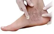 این علائم در پا را جدی بگیرید