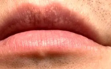  لکه های سفید روی لب چه دلیلی دارند؟

