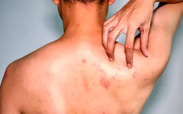 علائم زونا و اهمیت تشخیص به موقع آن