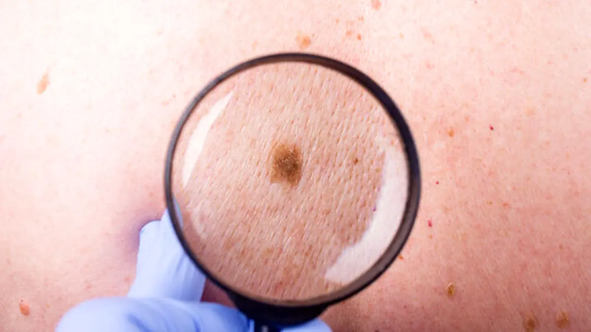 سرطان پوست | شایع‌ترین انواع سرطان پوست کدام است؟