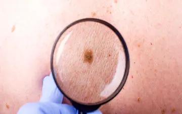 سرطان پوست | شایع‌ترین انواع سرطان پوست کدام است؟