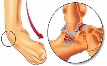  آیا مکررا دچار پیچ خوردگی مچ پا می شوید؟