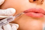 راز لب‌های طبیعی و جذاب: چقدر ژل تزریق کنیم که مصنوعی نشه؟