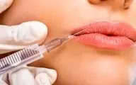 راز لب‌های طبیعی و جذاب: چقدر ژل تزریق کنیم که مصنوعی نشه؟