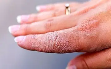 درمان خانگی و طلایی برای خشکی بین انگشتان