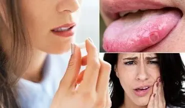زخم های دهان را چگونه درمان کنیم؟