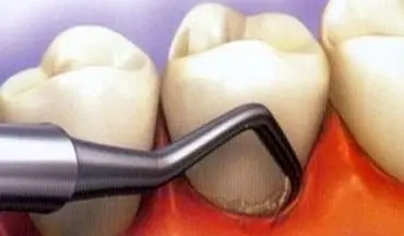  دندان را با مواد سفید پر کنیم یا سیاه؟