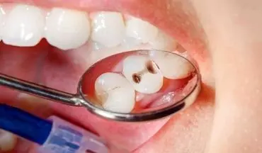 چرا دندان‌هایمان تند تند پوسیده می‌شوند؟