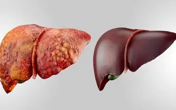 خودتان را لاغر کنید تا از شر کبد چرب راحت شوید
