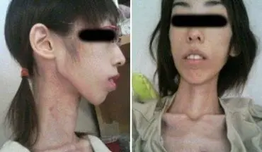 شکنجه دختر جوان ژاپنی با ۱۷ کیلوگرم وزن