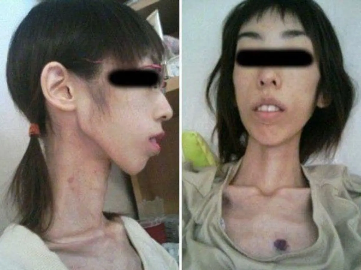 شکنجه دختر جوان ژاپنی با ۱۷ کیلوگرم وزن