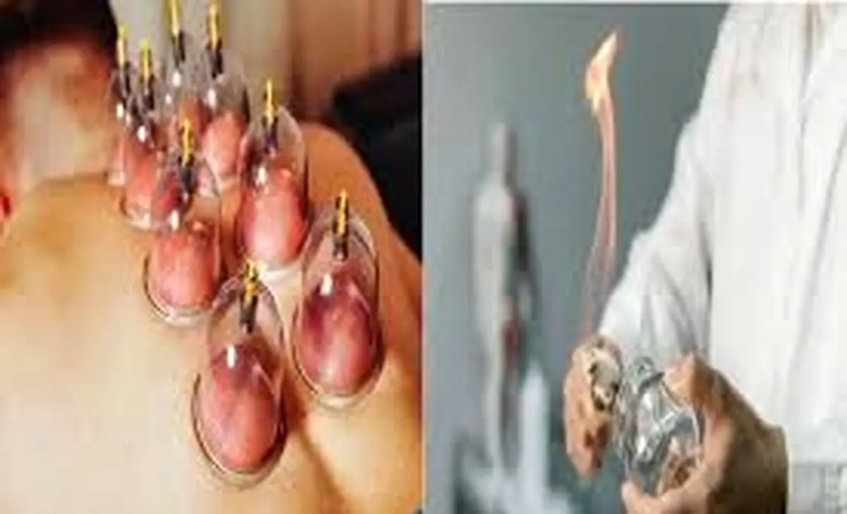   ۶ گروهی که حجامت در بهار برایشان مثل سم است! 