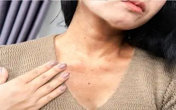 خطرناک‌ترین نشانه مصرف زیاد قند چیست؟ مراقب این تغییر عجیب پوستی باشید