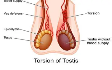 ورم بیضه در نوزادان