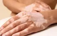 نکات بسیار مهم درباره لک‌های پوستی که تا الان نمی دانستید