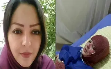 وضعیت دختر قربانی اسیدپاشی توسط همسرش + عکس