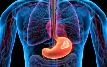 بررسی اجمالی ابتلا به سرطان معده